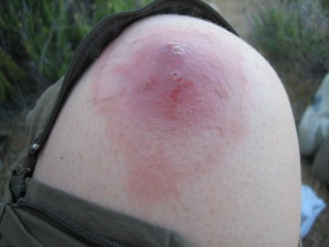 Infected Knee